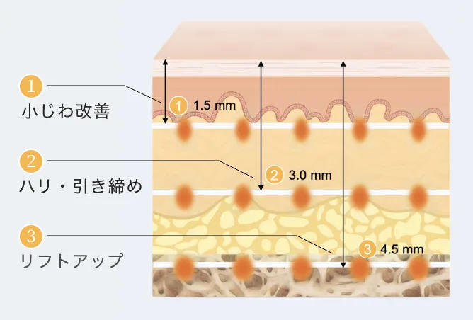 HIFUを1.5mm・3.0mm・4.5mmの深さに照射し、小じわ改善・ハリ引き締め・リフトアップにアプローチする模式図