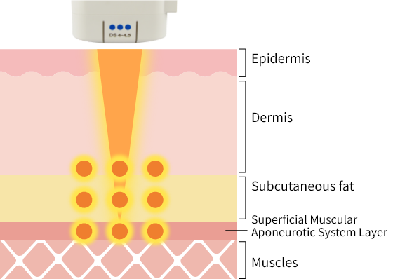 脂肪層・SMAS層